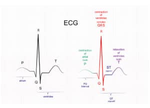 ecg ectopic interpretation