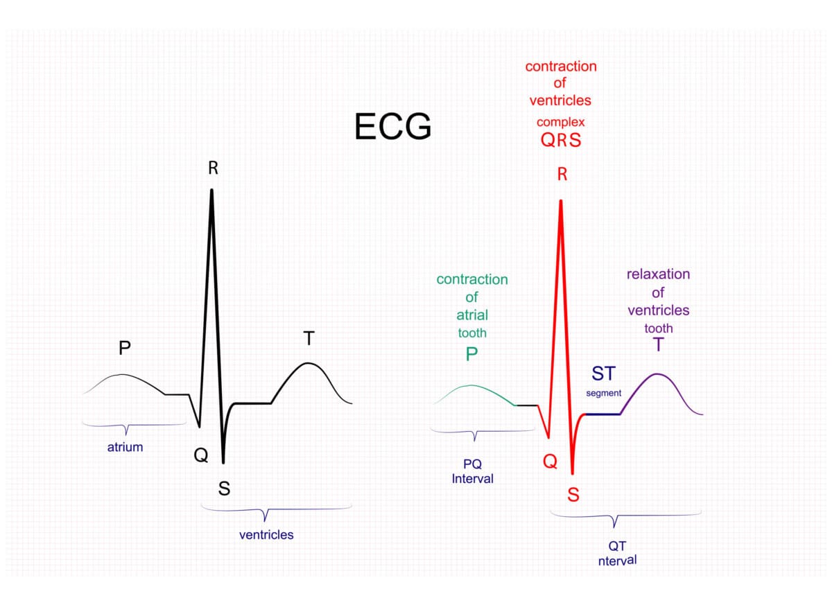 atrial-fibrillation-heart-rhythm-consultants